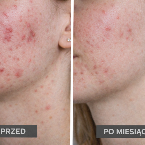 Historia Pani Karoliny, lat 29 – walka z trądzikiem, IO, poprawa zdrowia i uzupełnienie niedoborów pokarmowych, w msc – 1,9 kg